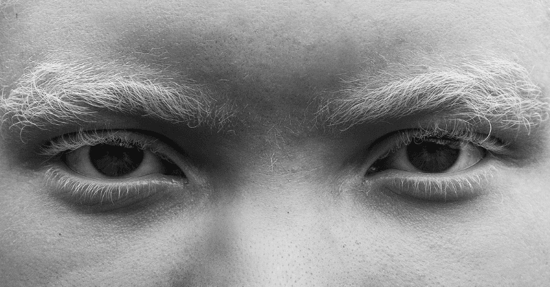 Nigeria Is No Haven for People With Albinism